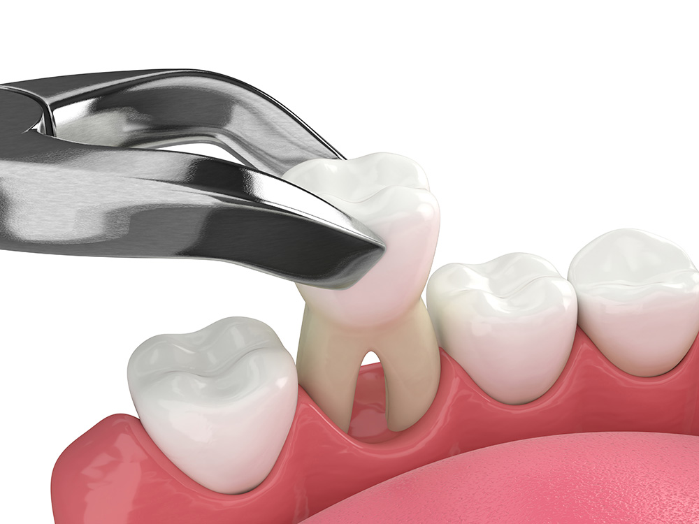 tooth removal in winnipeg