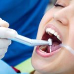 different types of dental fillings and their benefits