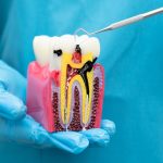 When is a Root Canal Necessary? Understanding the Signs