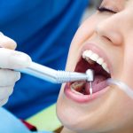 Dental Fillings: A Simple Way to Save Your Tooth