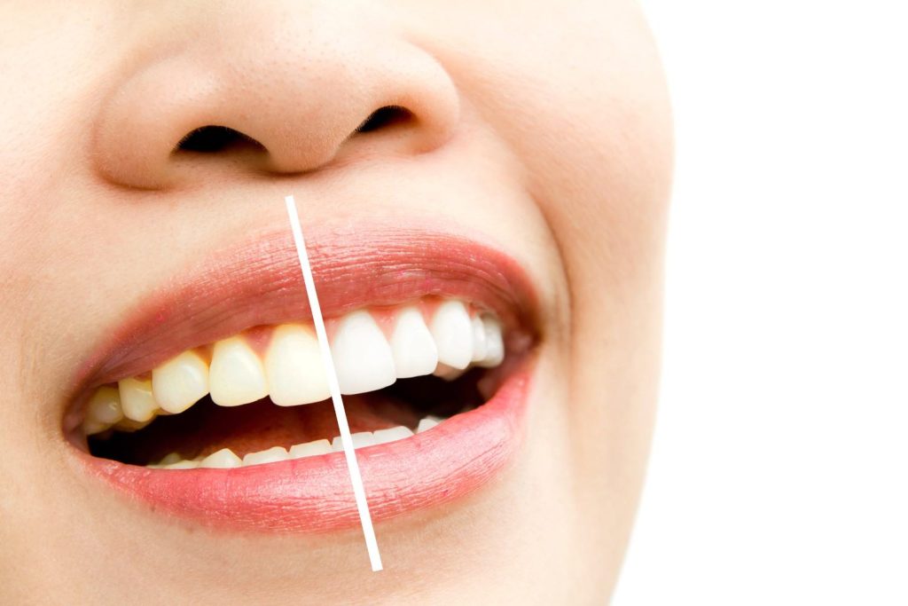 Why Do Teeth Stain Common Causes and Prevention Tips