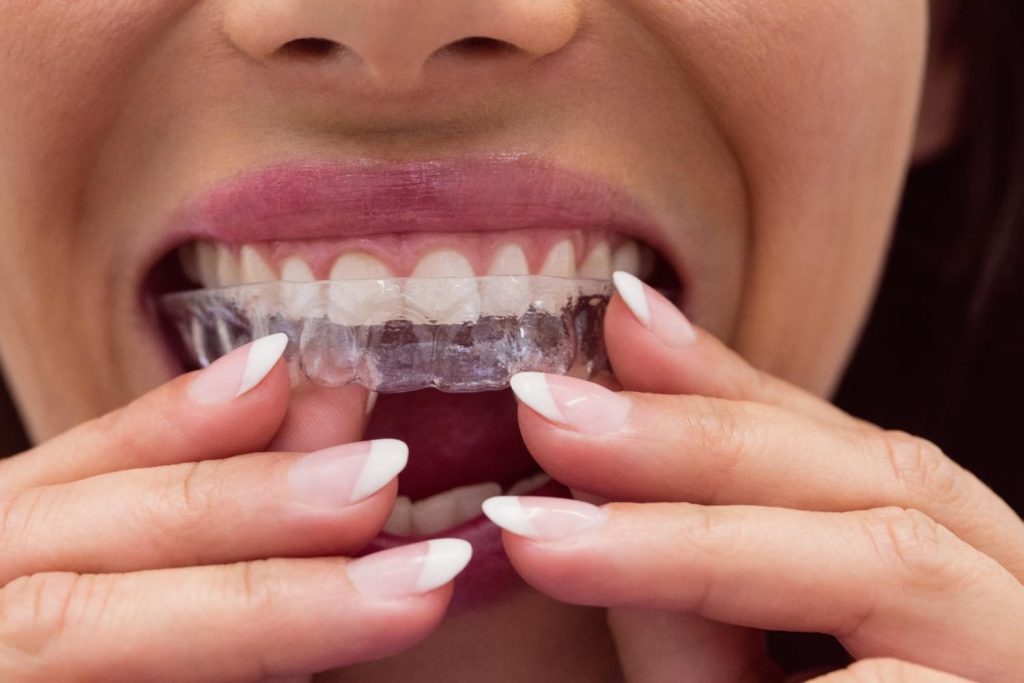 How Do You Know If You Need a Night Guard for Teeth?
