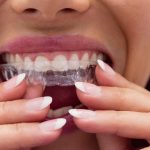 How Do You Know If You Need a Night Guard for Teeth?